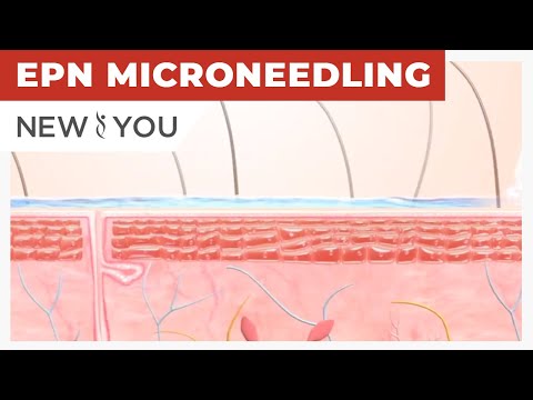 EPN MICRONEEDLING | Treatments | New You Med Spas