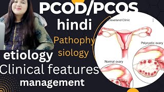 Polycystic ovarian syndrome|| PCOD || PCOS || HINDI|| Etiology, features, pathophysiology|