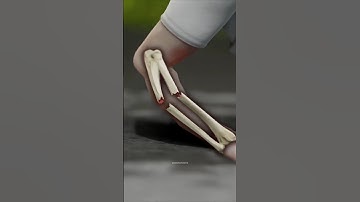 You Should Never Ignore A Broken Bone