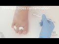 PediSafe Extreme Toenail Reconstruction