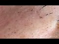 【Plucking facial hair】ずっと見ていられる賜物のヒゲ抜き　2023 3 31（アゴヒゲ抜き毛根鞘プルプル祭り）【Pull out the beard】