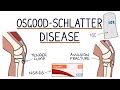 Understanding Osgood-Schlatter Disease