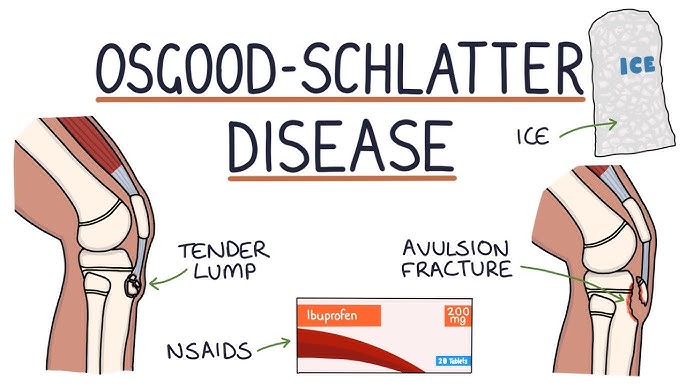 Osgood Schlatter Disease in Adults: Treatment for Knee Pain