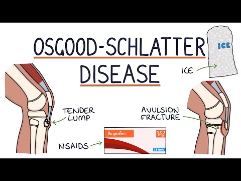 Video: Osgood-Schlatter disease