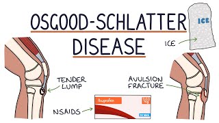 Understanding OsgoodSchlatter Disease