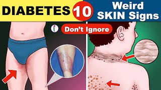 Diabetes skin signs | Diabetes symptoms | Signs of Diabetes | Diabetes mellitus | Type 1 diabetes