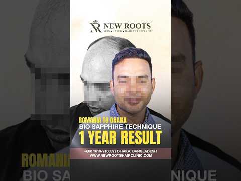 Sapphire Hair Transplant in Bangladesh | Grade 6 Baldness | Best Cost and Best Results #shorts