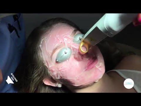 Acne Redness and Telangiectasia Caused By Acne Excel V Laser Treatment with Full Explanation