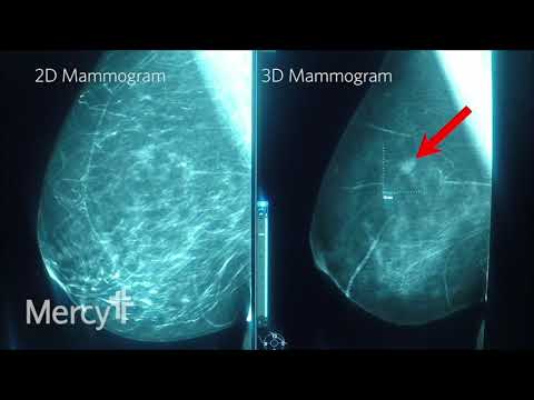 Video: 3-D Mamogram: Náklady, Výsledky A ďalšie