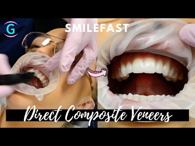 Uveneer: Simplifying Artistic Direct Composite Veneering - Dentistry Today