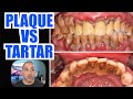 Plaque Vs Tartar { How to Remove Plaque on Teeth & STOP Dental Calculus }