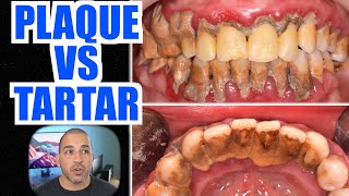 Plaque Vs Tartar { How To Remove Plaque On Teeth & Stop Dental Calculus }