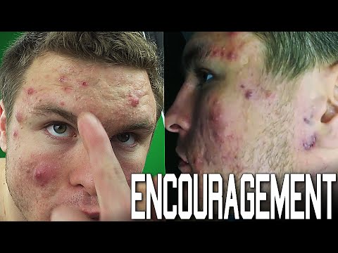 Encouragement for People Suffering With Acne