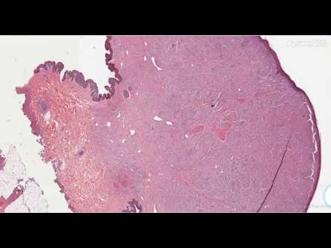 Video: BRAF V600E-mutation I Juvenil Xanthogranuloma-familj Neoplasmer I Centrala Nervsystemet (CNS-JXG): En Reviderad Diagnostisk Algoritm För Att Inkludera Pediatrisk Erdheim-Chester-sj