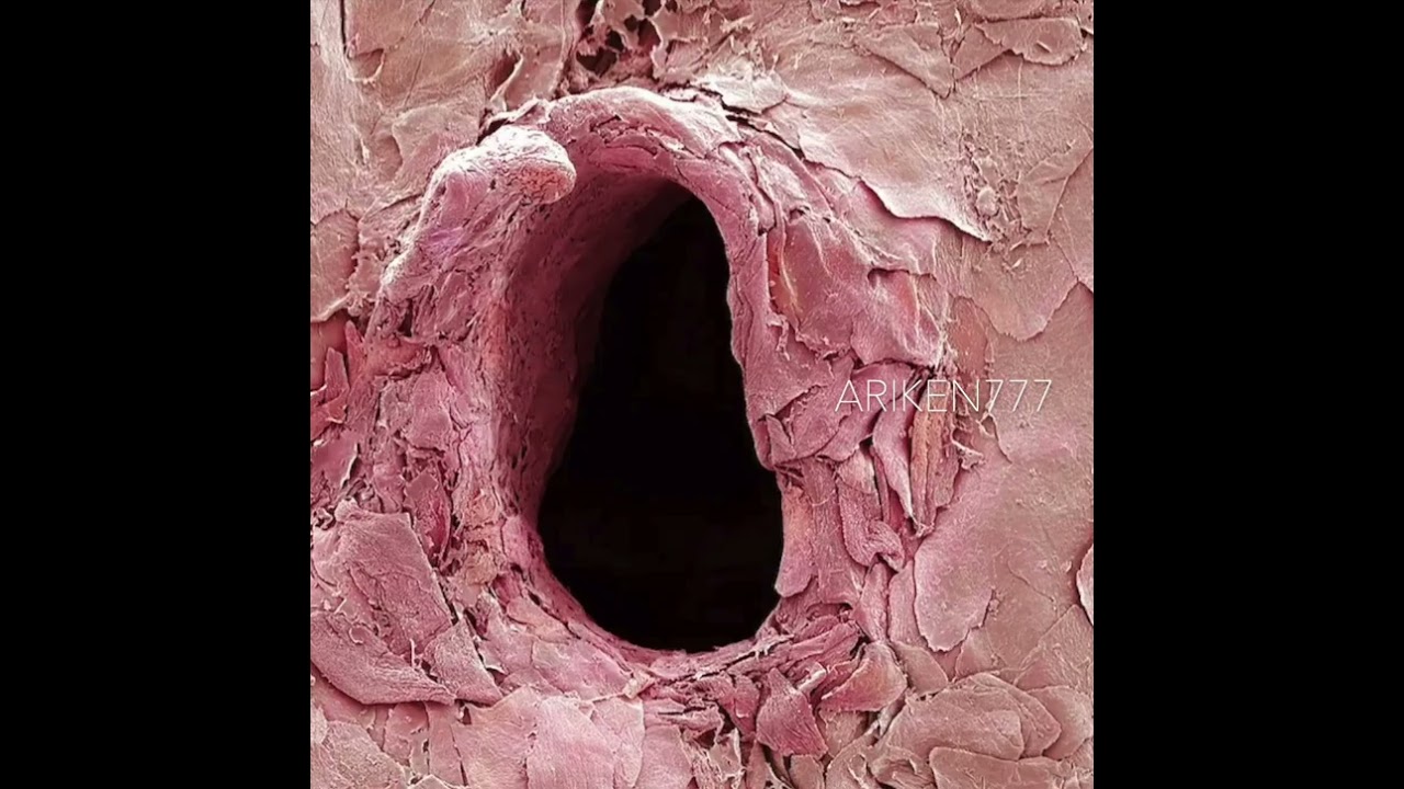 Microscopic view of a hole from a needle puncturing your skin 