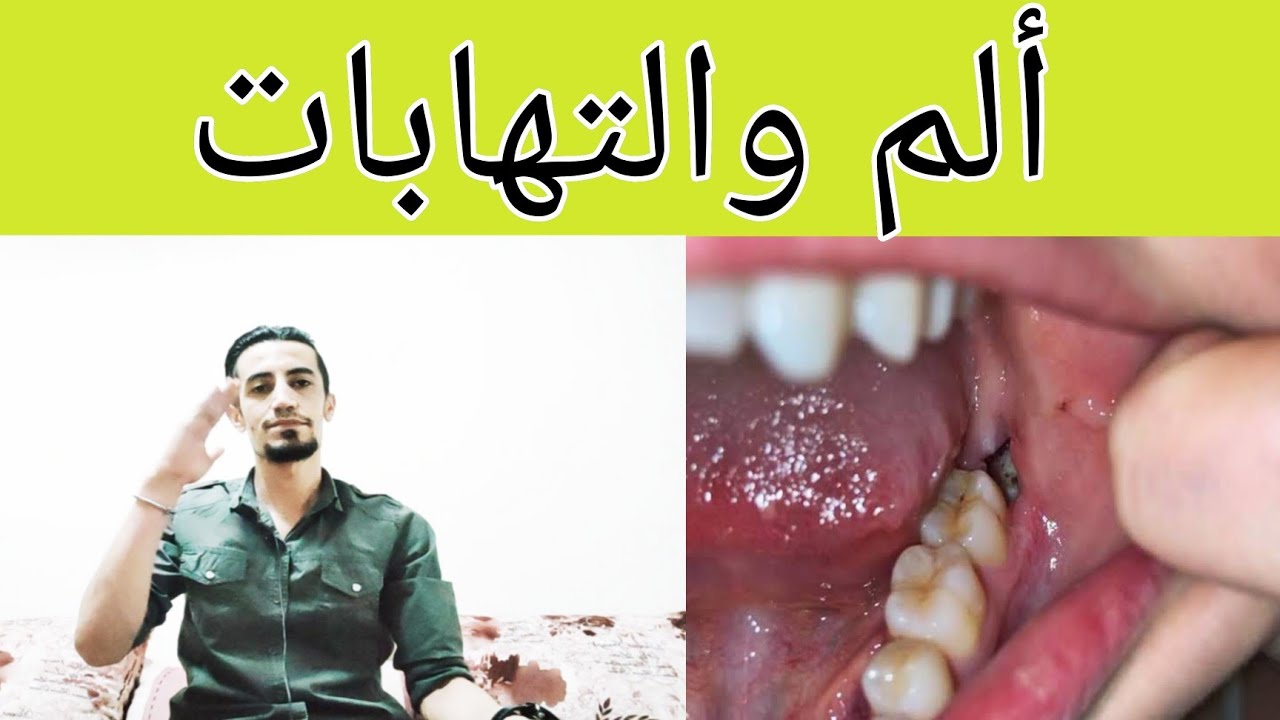 علاج وتسكين الألم والالتهاب بعد خلع الضرس👉