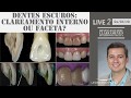 Dentes escuros: clareamento interno ou facetas - Conteúdo Live 2