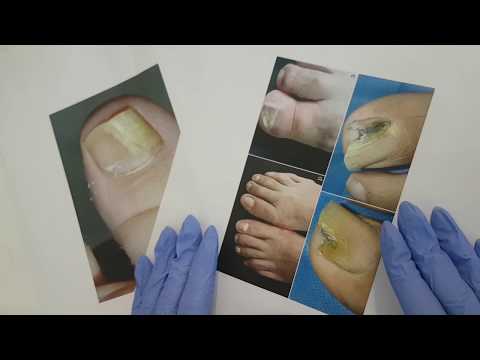 Video: Hiponichiu (pielea De Sub Unghii) Cauze De îngroșare și Tratament