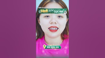 Niềng răng có hết cười hở lợi?? #nhakhoa #niengrang #nhatkyniengrang