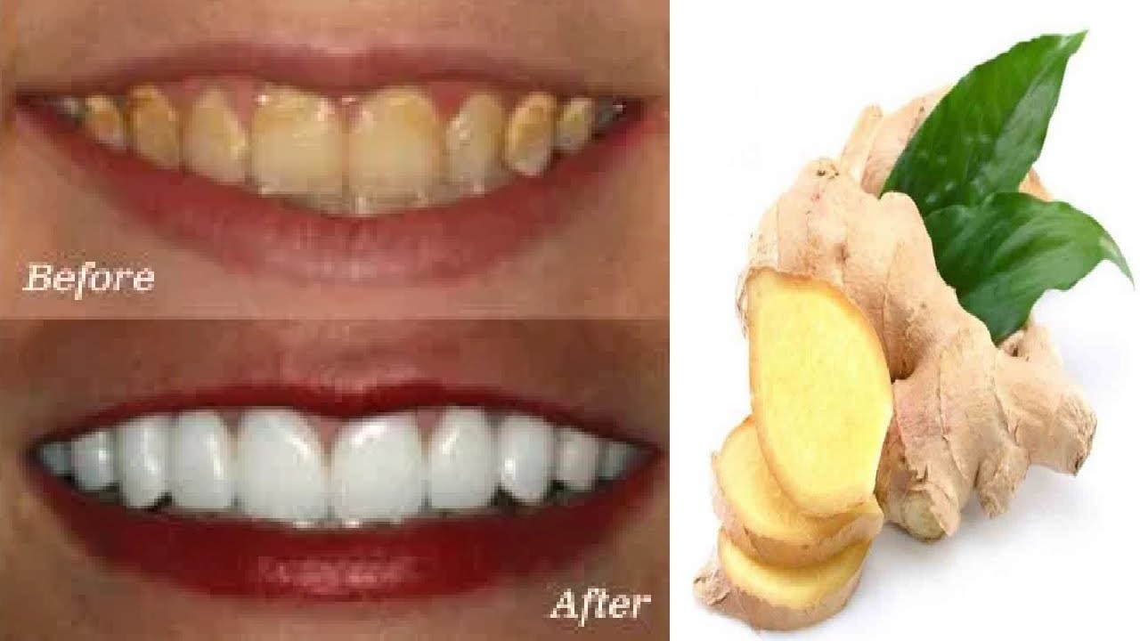 How to Whiten Your Teeth at home Teeth whitening hacks Teeth