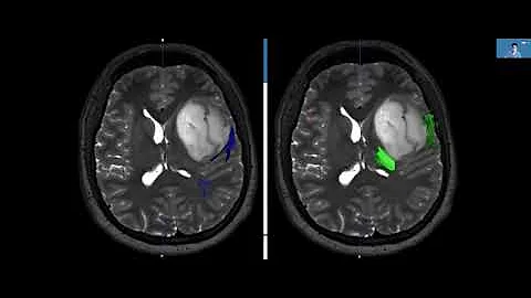 Neurosurgical Techniques and Maximizing Safe Resection: UCLA Brain Tumor Virtual Conference 2022