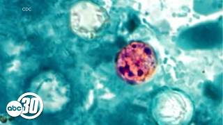 Cyclosporiasis case in Fresno County not linked to outbreak, officials say