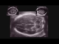 Basics in Perinatal Neurosonography