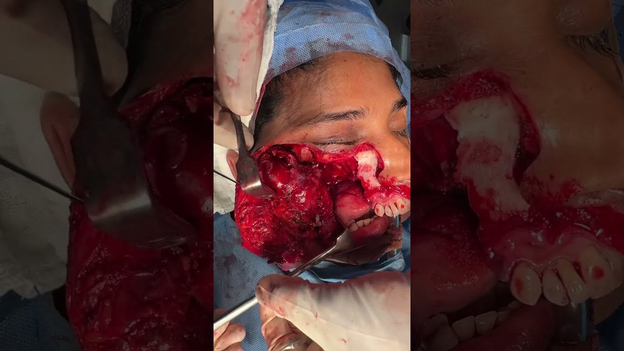 Open Face Approach For Tumour Removal Surgery Weber Ferguson Extension