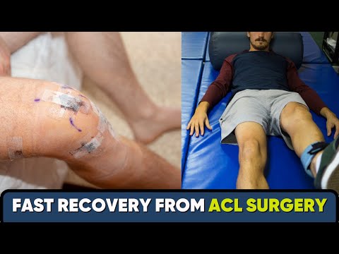 Fast recovery from ACL surgery-ACL सर्जरी से फ़ास्ट रिकवरी- English Subtitles- Dr Pankaj Walecha