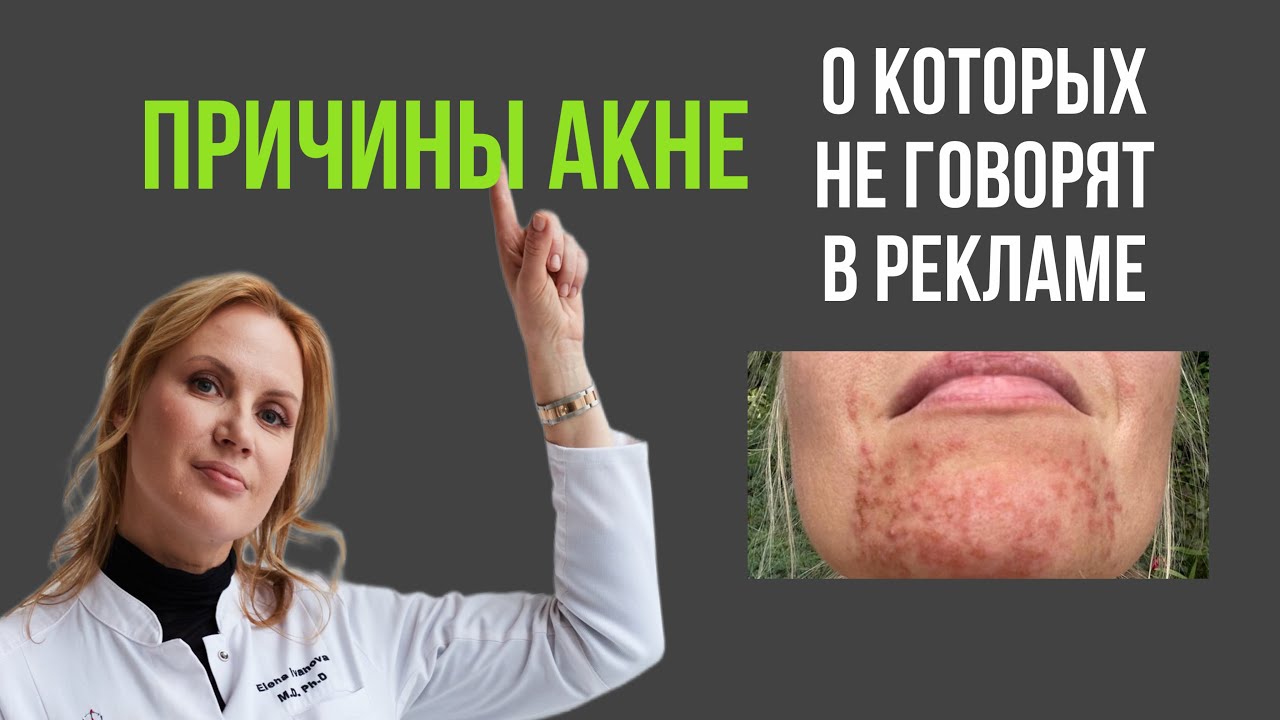Прыщи на лице, на подбородке, причины, как убрать, советы врача дерматолога