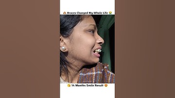 🔥💀 Braces Transformation Before & After 14 Month || #ytshorts #trending #shorts