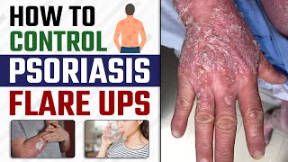 How to Control Psoriasis Flare Ups | Best Tips to Control Psoriasis in Summers | Dr. Health