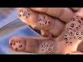 Trypophobia Hands in Real Life! Filled with Jiggers!