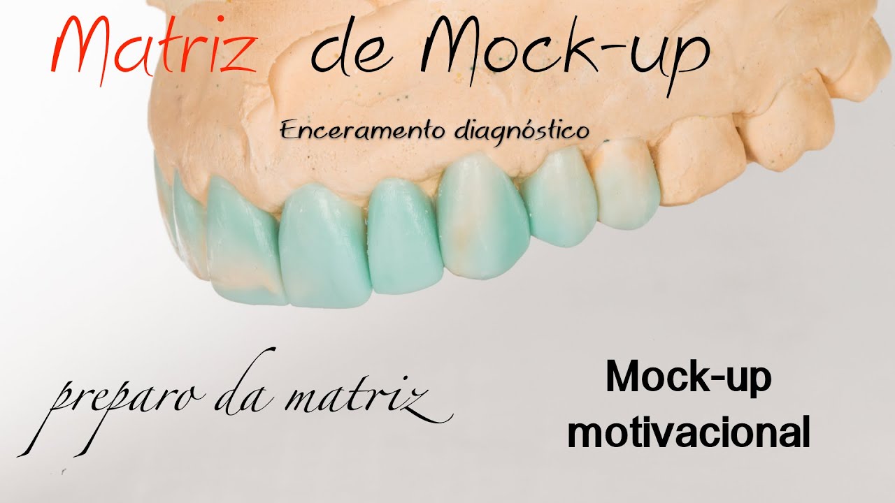 Técnica de matriz de silicone para Mock-up emotivo e/ou laminados provisórios