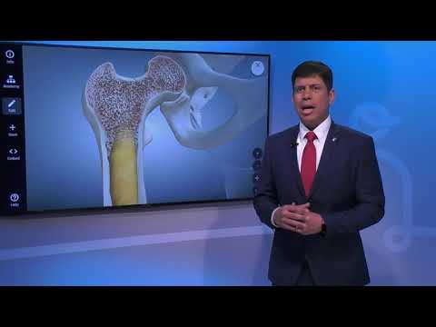 Videó: Osteoporosis Kezelése - Az Osteoporosis Kezelésének 5 Modern Módszere