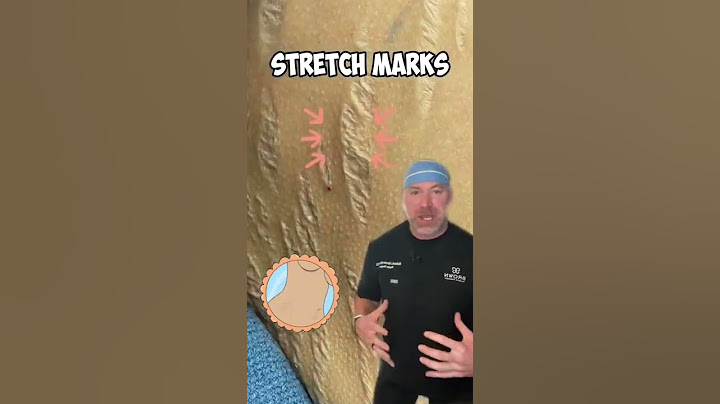 What Causes Stretch Marks? 😩 #shorts