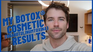 MY BOTOX® COSMETIC (onabotulinumtoxinA) TREATMENT AND RESULTS | Taylor and Jeff