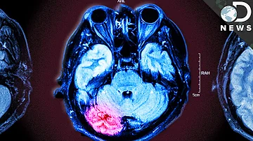 What percentage of boxers suffer brain damage?