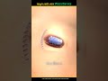আঙুল কেটে গেলে ডাক্তার কীভাবে ঠিক করবে ।😱#shorts
