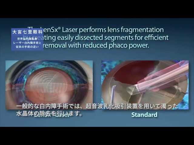 最新レーザー白内障手術と従来の手術の違い 大宮七里眼科 - YouTube