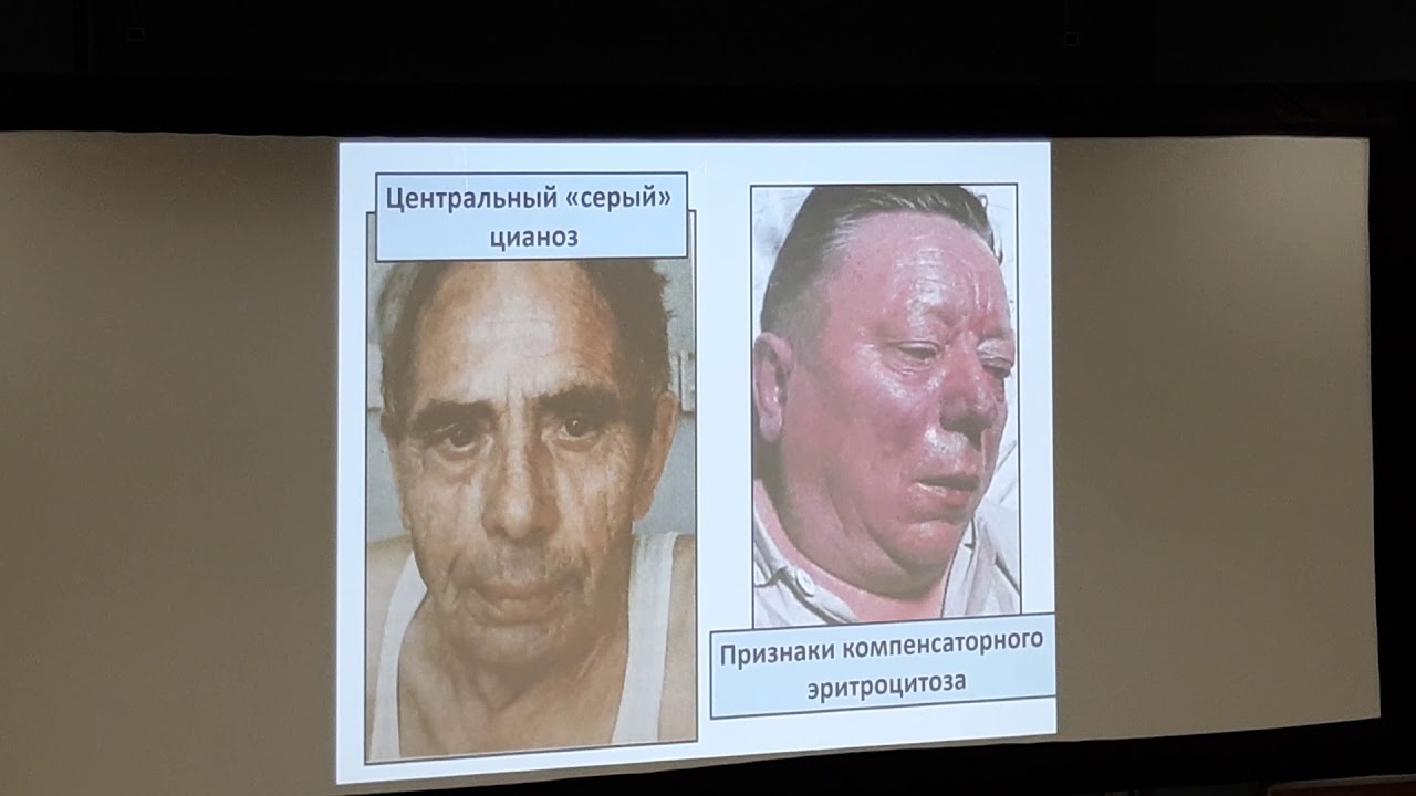 Хронический бронхит и ХОБЛ. Пропедевтика. Струтынский. Часть 3 - YouTube