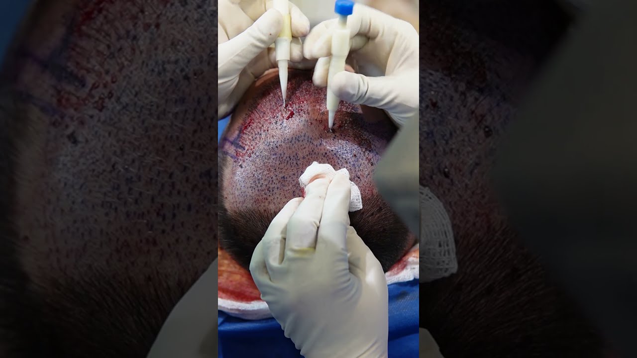 FUE Hair Transplant With DHI Technology 