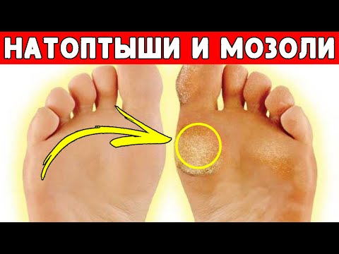 Как НАВСЕГДА избавиться от НАТОПТЫШЕЙ и МОЗОЛЕЙ  Очень ПРОСТОЙ, но очень ЭФФЕКТИВНЫЙ СПОСОБ