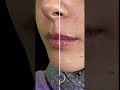 Dudak Dolgusunda Uzm Dr Peyami Duman Tekniト殃 Shorts Shortsvideo Shortvideo Dudak Dudakdolgusu Dudak Dolgusunda Uzm Dr Peyami Duman Tekniト殃 Shorts Shortsvideo Shortvideo Dudak Dudakdolgusu