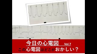 今日の心電図Vol 7　臨床でちょいちょ出てくる嫌なやつ　これを見たら要注意！