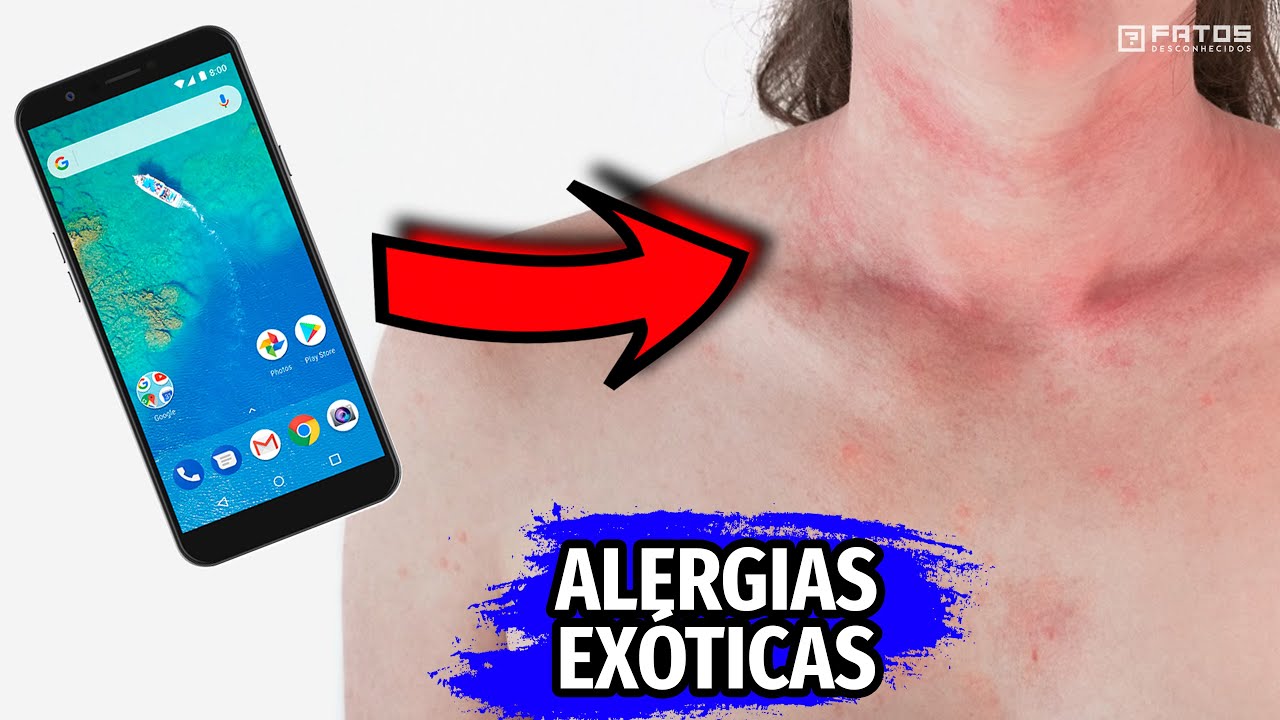 As alergias mais exóticas do mundo?