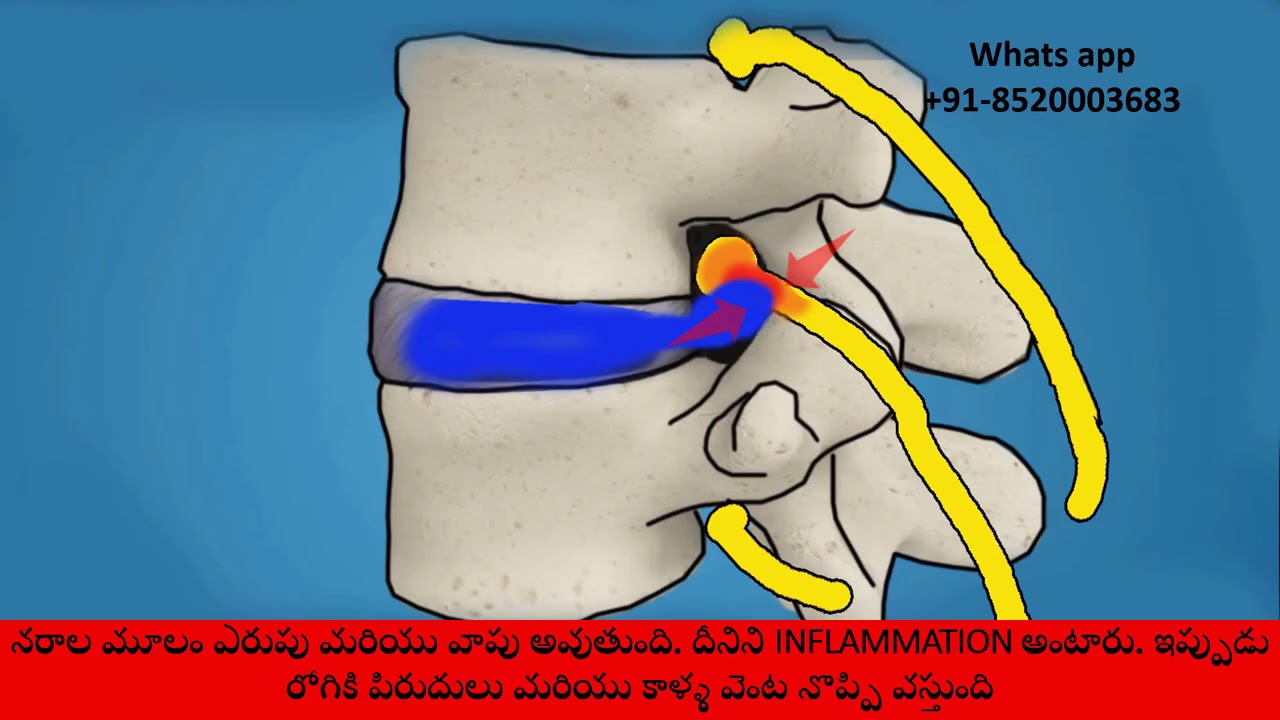 10 How does SLIP DISC cause back pain and leg pain 1 YouTube