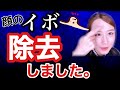 【顔のデキモノは要注意！？】いぼ焼いてきました【皮膚科/イボ除去】保険治療、痛さ、方法について