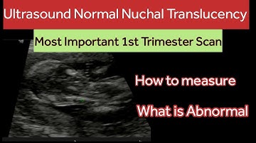 1st Trimester Pregnancy | Nuchal Translucency Ultrasound |