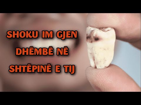 Video: A supozohet të lëndojnë dhëmbët e mençurisë?